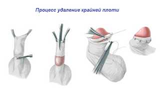 Опух член и крайняя плоть
