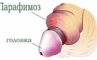 Синехии крайней плоти у мальчиков — что делать?