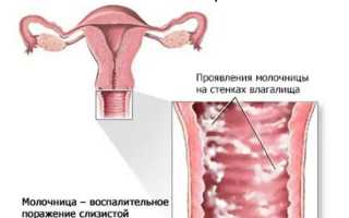 Чем снять зуд при молочнице