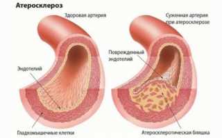 Применение статинов от холестерина