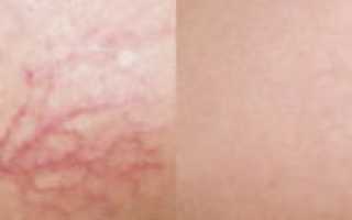 Как быстро убрать сосудистые звездочки на лице?