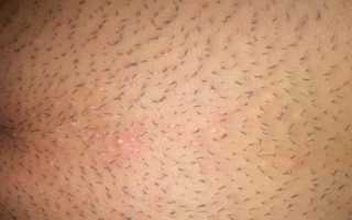 Раздражение от бритья в интимной зоне