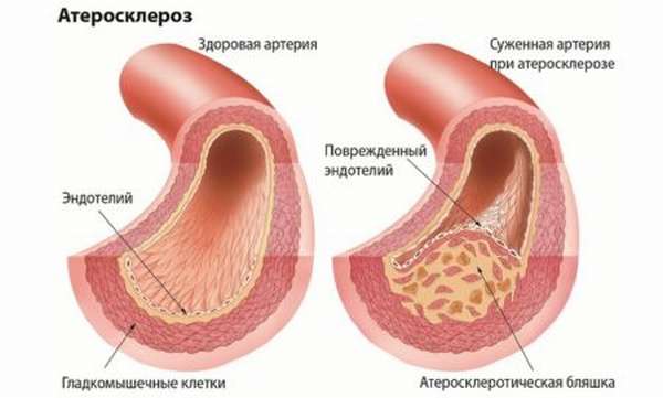 Специфика приема статинов от холестерина, возможная польза и вред от их приема